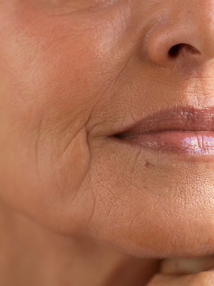 Aging Skin