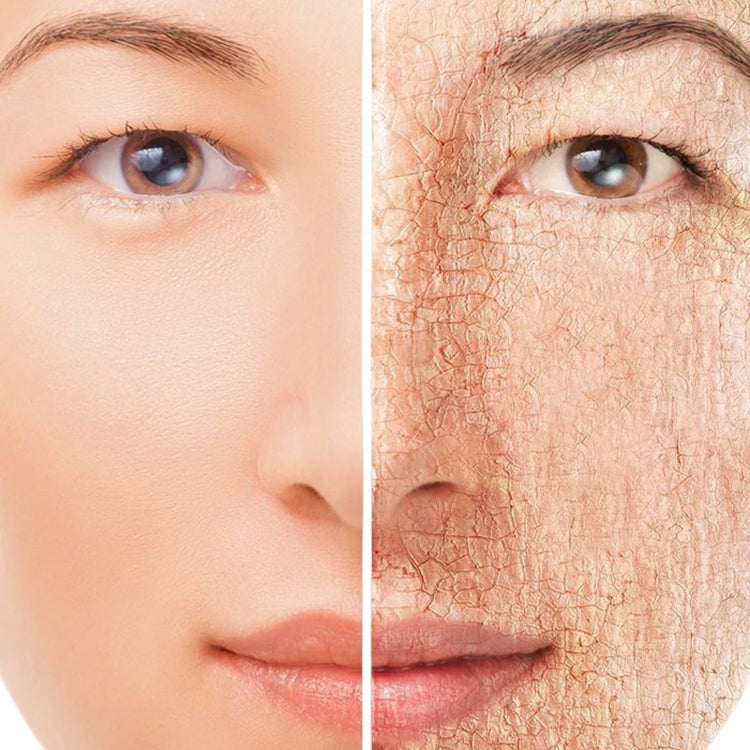 Dry Skin