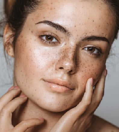 dark spots